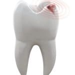 Cavities Hoover Dental Patients