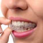 Cross-bite Correction and Treatment Options Hoover Alabama