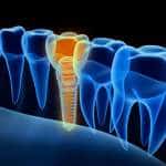 Dental Implants – Birmingham Dentists