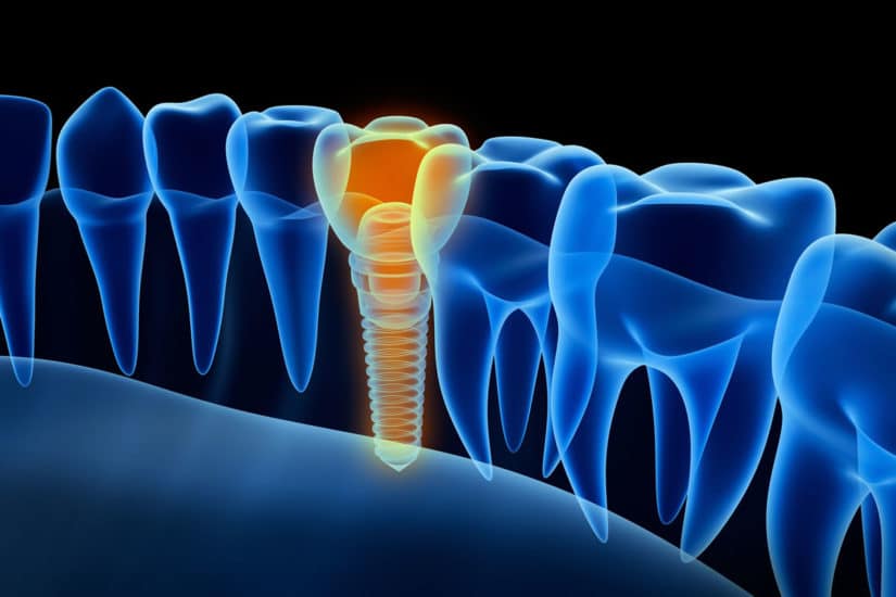 Dental Implants – Birmingham Dentists