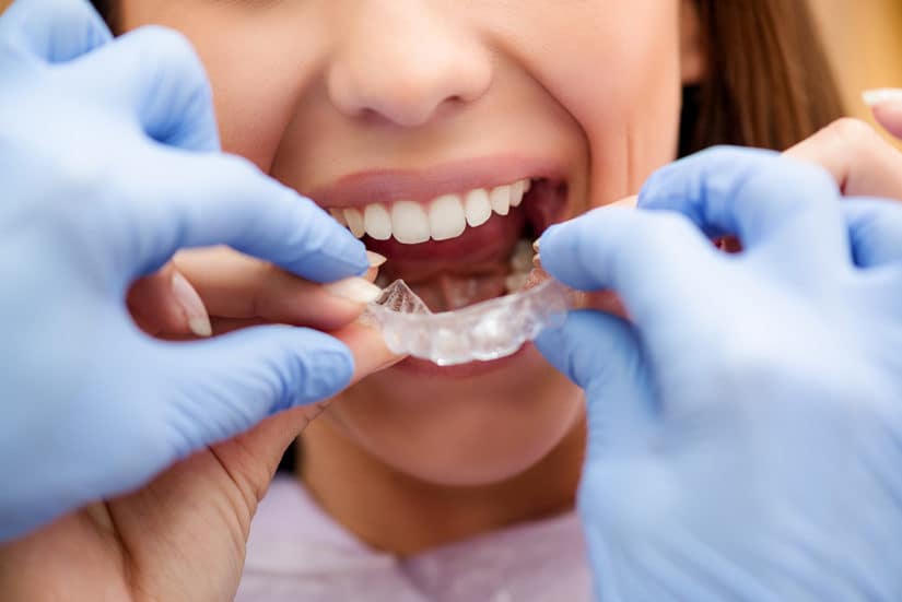 Will I Have Allergic Reaction to Invisalign - Hoover AL Dental