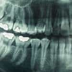 Are Dental X-Rays Ok For Children
