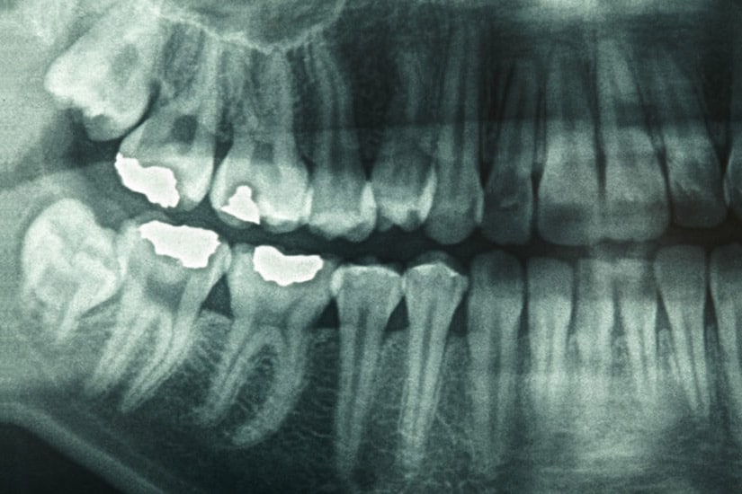 are dental x-rays ok for children living in Birmingham Alabama