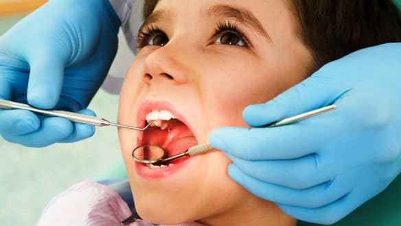 Why Children Need Cavities Filled in Hoover Alabama