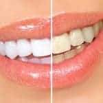 Top 3 Reasons To Whiten Your Teeth