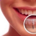 Do I Need to Replace a Missing Tooth?