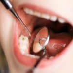 What Causes Tooth Decay?