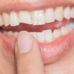 chipped tooth-hoover alabama dental clinic